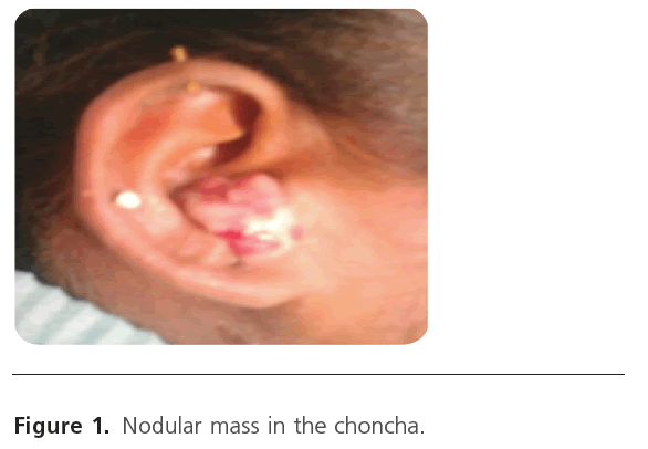 translational-biomedicine-Nodular-mass