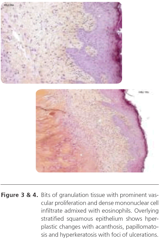 translational-biomedicine-granulation-tissue